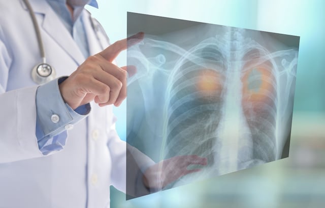 Crean sistema con inteligencia artificial que puede detectar enfermedades pulmonares con un 98% de precisión