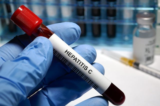 Laboratorios ofrecerán pruebas gratuitas de hepatitis C