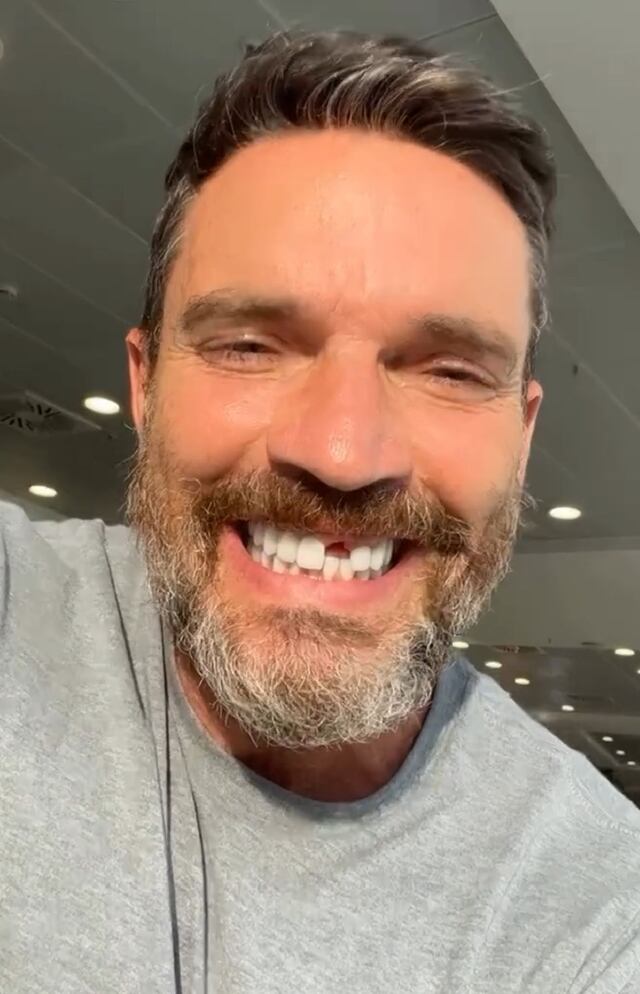 Julián Gil revela que perdió un diente durante su estancia en “La Isla: Desafío Extremo”