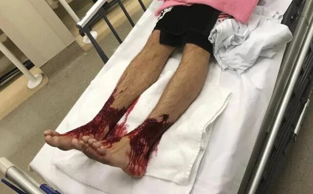 Resuelven misterio de las criaturas marinas carnívoras que casi devoran piernas a joven en Australia