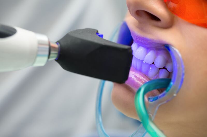 51062335 - girl patient in the dental clinic. teeth whitening uv lamp with photopolymer composition.