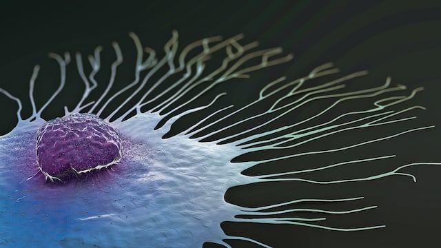 ¿Cáncer de Seno Triple Negativo, que es? ¿Se trata diferente?
