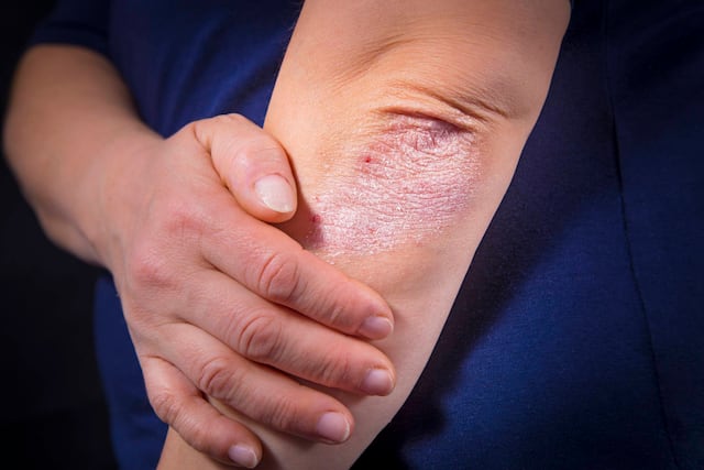 Celebrarán actividad educativa para pacientes de psoriasis