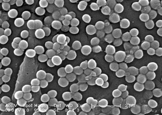 Nuevo caso de infectado con bacteria que devora carne en Florida