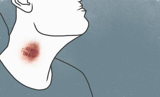 Joven muere por un 'chupetón' en el cuello