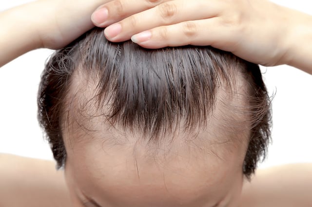 FDA aprueba medicamento para pérdida de cabello en adolescentes y adultos