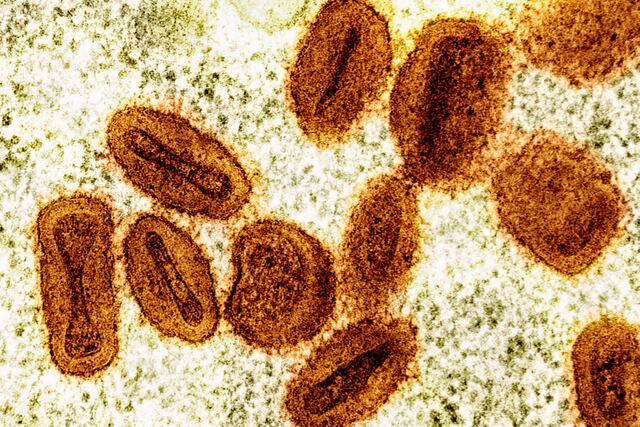 Reportan el primer contagio de un nuevo tipo de viruela símica en viajero en Estados Unidos