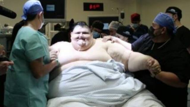 ​El hombre más obeso del mundo es operado con éxito en México