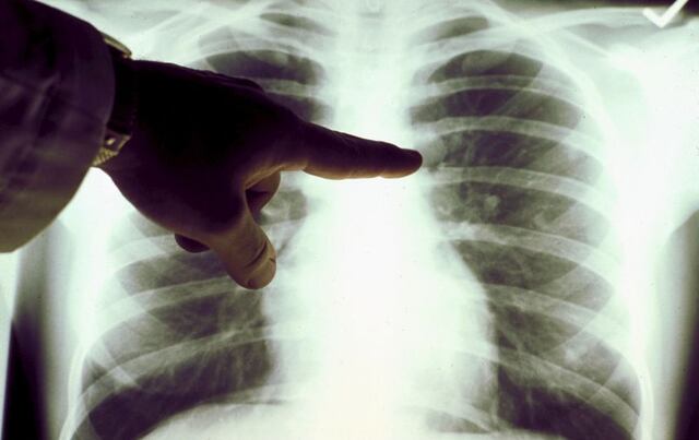 Hombre muere por parásito en su estómago enfermarse de cáncer