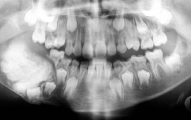 Extraen 232 dientes a joven de la India