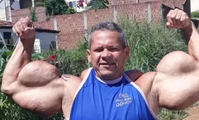 Fallece el “Popeye brasileño”: hombre que se inyectaba aceite mineral para aumentar sus músculos