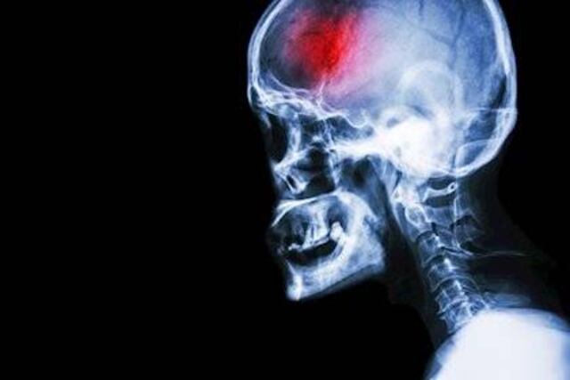 Recomendaciones para identificar un accidente cerebro vascular