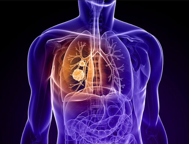 Alternativa para pacientes con enfermedad pulmonar obstructiva crónica