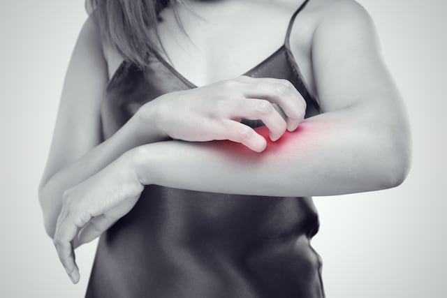 Celebran Día de Concienciación de la Dermatitis Atópica
