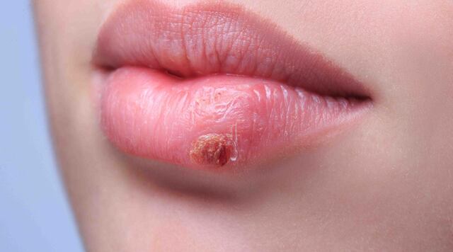 Entérate de cómo tratar el herpes labial