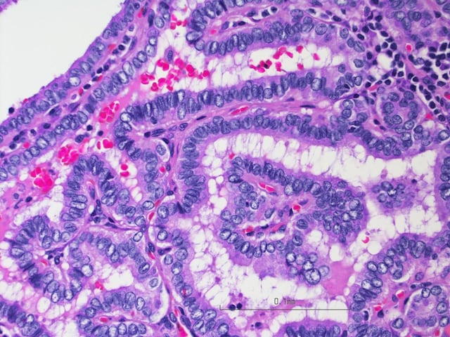 El cáncer de hígado y páncreas es el más recurrente entre hispanos, según estudio