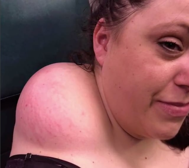 Creció por tres años: el desagradable momento en que doctora enfrenta una "espinilla mutante" en el cuello de su paciente