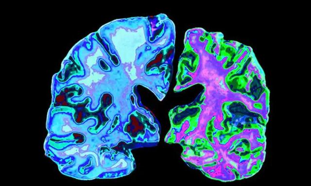 Nuevo estudio indica que el consumo de cerveza puede proteger a las personas de sufrir Alzheimer