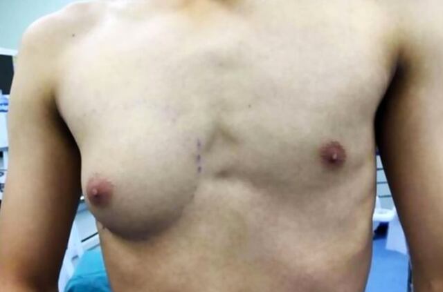 El extraño caso del hombre al que le creció un solo seno: doctores culpan a la comida chatarra