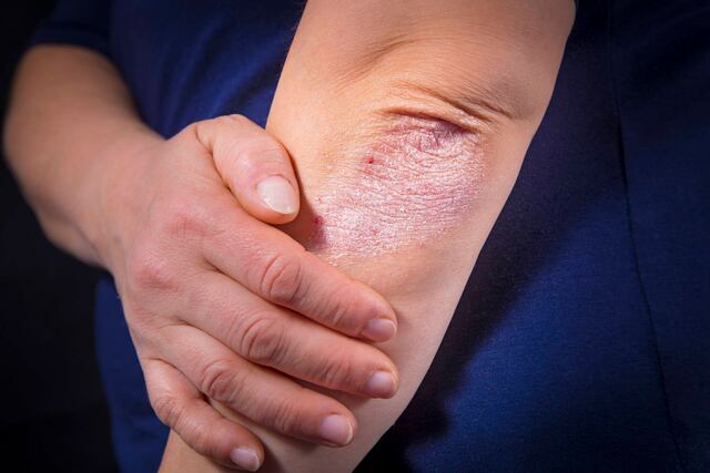 AbbVie presenta psoriasispr.com en Puerto Rico: una nueva página web educativa sobre la Psoriasis