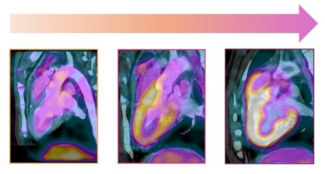 Hipertensos son más susceptibles a los daños que causa un fármaco contra el cáncer