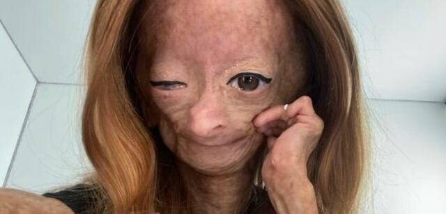 Muere Adalia Rose, la joven que se hizo viral por un síndrome de envejecimiento