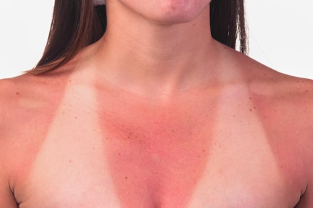 Cinco consejos para aliviar y prevenir quemaduras solares
