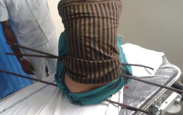 Joven sobrevive con 3 varas de metal enterradas en su cuerpo