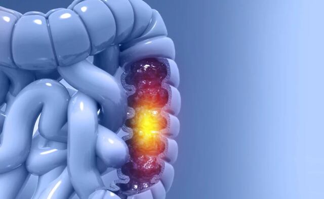 Más casos de cáncer colorrectal se hallan en adultos jóvenes