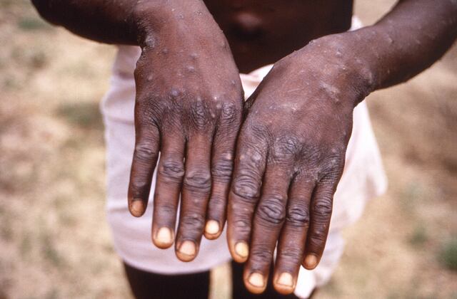 Estigma contra homosexuales podría agravar brote de viruela símica en el Congo, según científicos