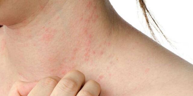 LA FDA de los Estados Unidos aprueba RINVOQ® (upadacitinib) para tratar a adultos y niños de 12 años o más con dermatitis atópica refractaria de moderada a severa