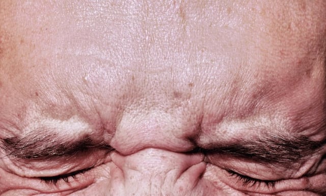 Alcohol, cafeína y aditivos alimentarios: Los tres principales causantes de la migraña