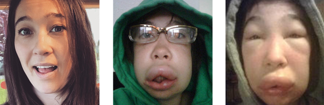 ¿Qué es el Angioedema Hereditario?