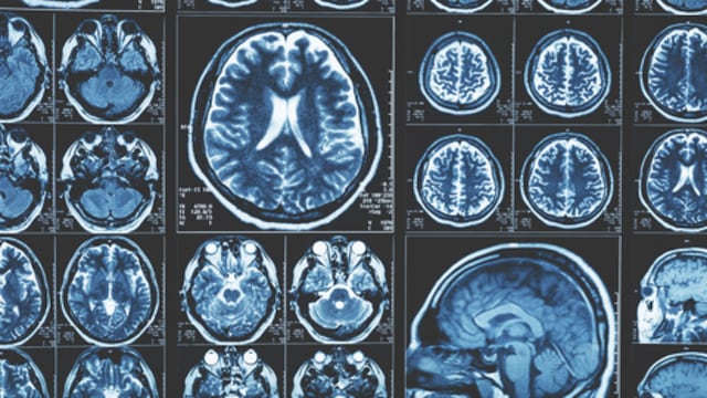 Consejos de un neurólogo para combatir la pérdida de memoria y el alzhéimer