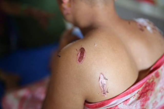 Atacan con ácido a niña de 8 años