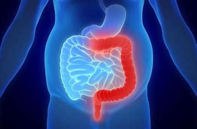 FDA aprueba medicamento para el tratamiento de colitis ulcerosa