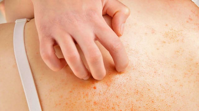¿Hay picor, rash y escamas?
