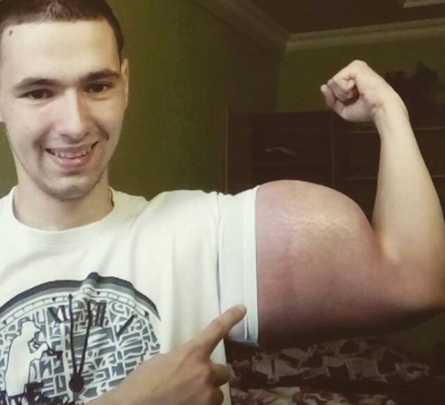 Polémico Popeye ruso se inyecta aceite en los brazos para romper récords