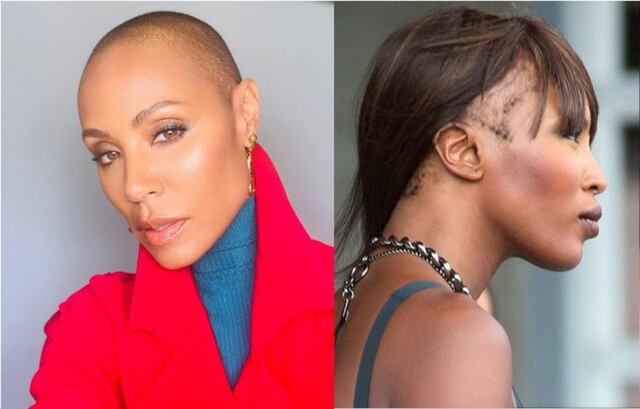 Estas son las famosas que siguen batallando contra la alopecia