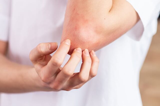 Pacientes de psoriasis enfrentan difícil acceso a servicios de salud, pobre calidad de vida