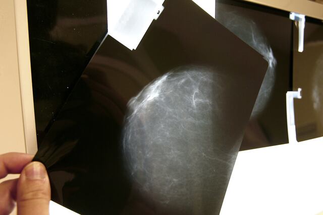 Casos de cáncer de mama aumentarían 34 % y muertes 44 % para 2050, advierte estudio