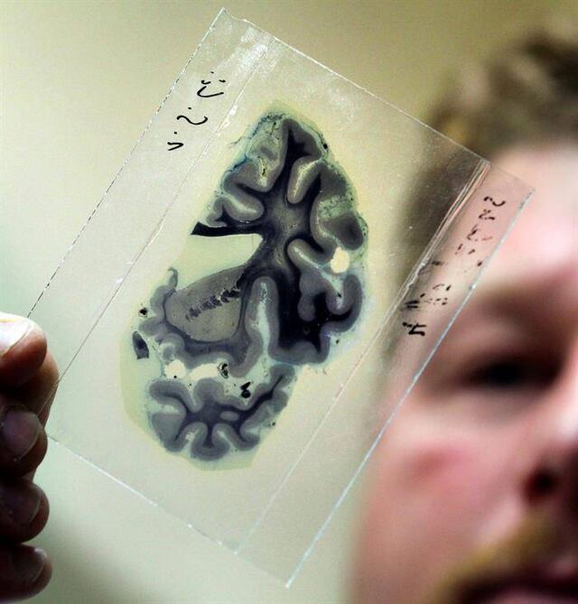 Nuevo descubrimiento puede ayudar a revertir pérdida de memoria en Alzheimer