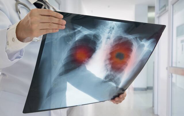 Exhortan a médicos a educarse sobre el avance terapéutico en cáncer de pulmón