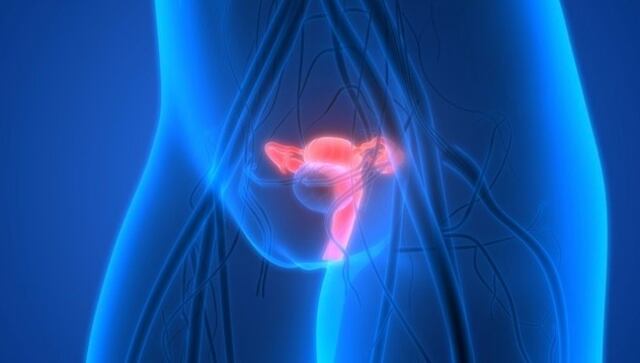 Cáncer de cuello uterino: Estos son los principales signos