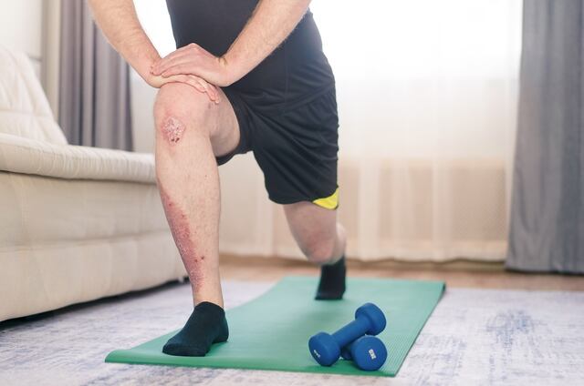 Psoriasis y ejercicio: ¡muévete para mejorar tu salud!