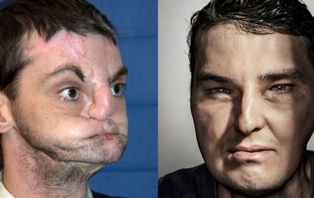 Después de un trasplante de rostro se convierte en modelo de GQ