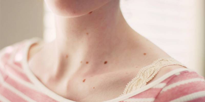 Presta atención a estos cambios en tu piel, podría ser cáncer