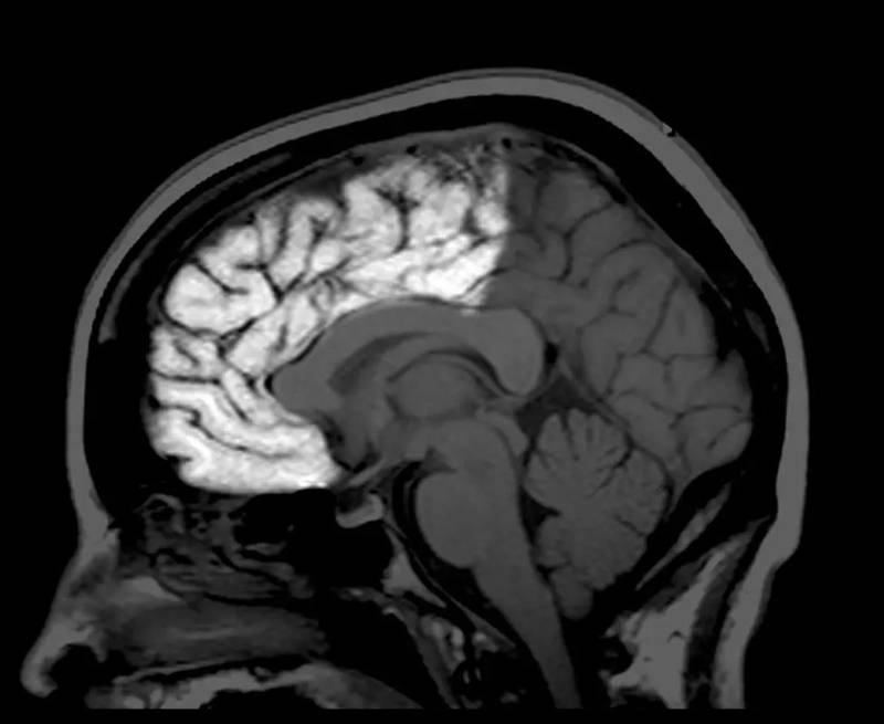 Cientificos descubren una capa adicional a la anatomía del Cerebro | Foto: Referencial