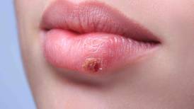 Entérate de cómo tratar el herpes labial