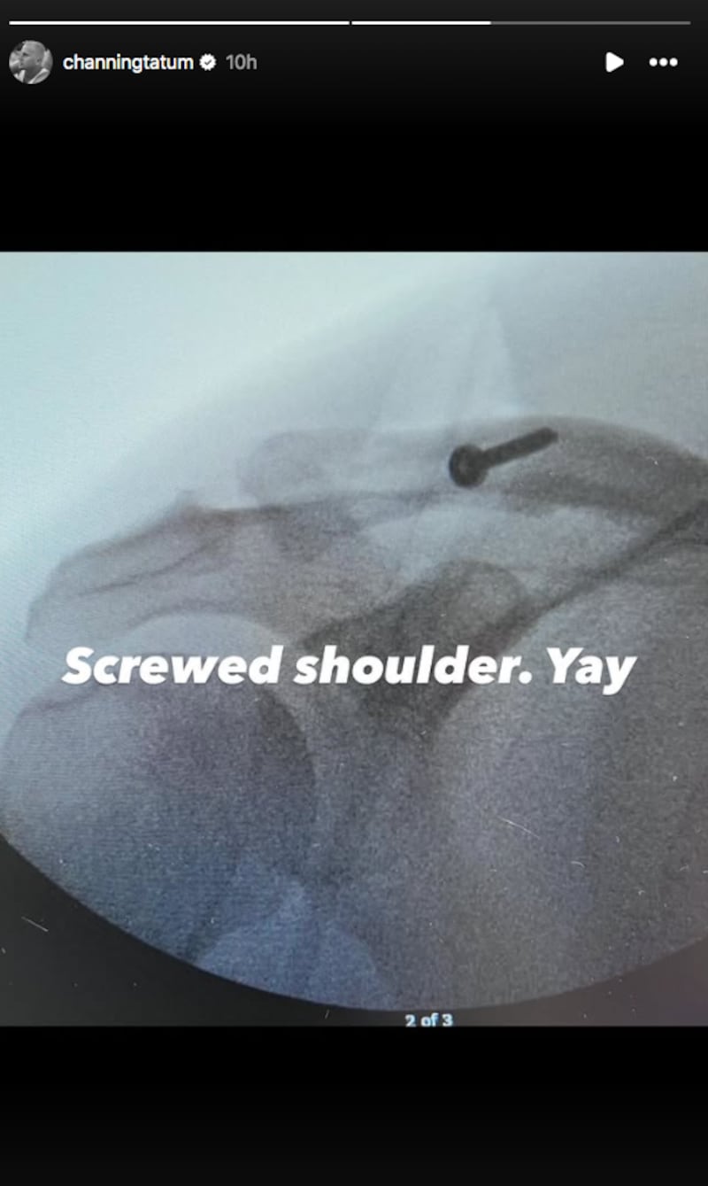 Lesión de Channing Tatum